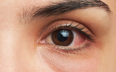 Glaucoma: consejos para detectarlo a tiempo